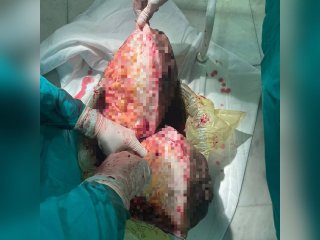 Уфимские врачи удалили 20-килограммовую опухоль из паховой области мужчины