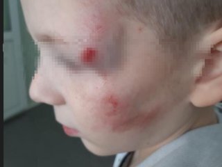 «Ребенок в больнице»: в Башкирии водитель сбил 8-летнего мальчика и бросил