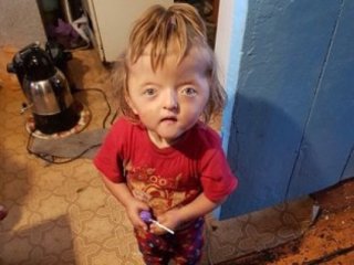 Девочке с деформированным лицом из Башкирии пообещали место в детском саду