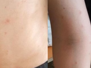 У пятерых детей появилась сыпь и зуд после купания на популярном пляже в Уфе