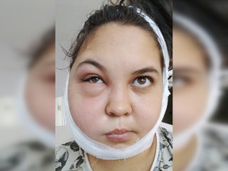 В Башкирии девушке вырвали другой зуб вместо больного