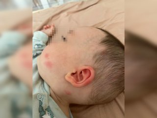 Жители Уфы по-прежнему страдают от укусов комаров после санобработки