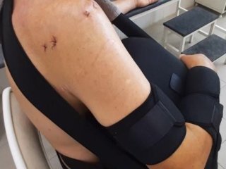 В Уфе врачи провели сложнейшую операцию на руке с тотальными повреждениями