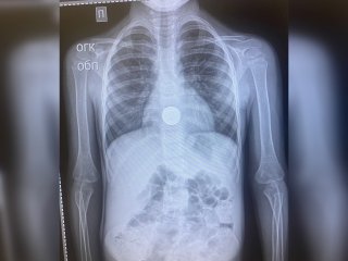 В Башкирии врачи спасли маленьких мальчика и девочку, которые проглотили монету и заколку