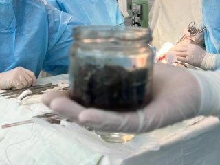 В Башкирии врачи спасли жизнь пациента, удалив из его желудка 300 граммов магнитных частиц