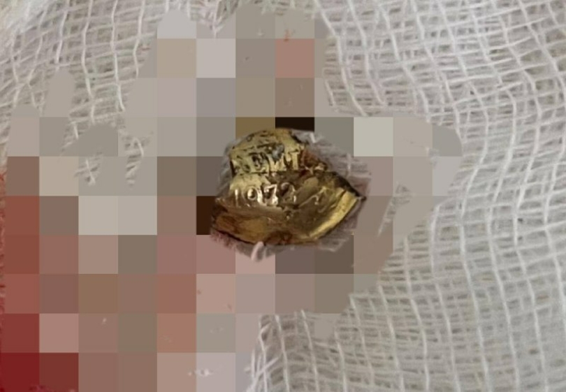 Уфимские врачи удалили фрагмент монеты участнику СВО после минно-взрывного ранения Уфимские врачи удалили фрагмент монеты участнику СВО после минно-взрывного ранения