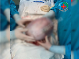 В Уфе врачи провели пенсионерке операцию по удалению огромной опухоли яичника