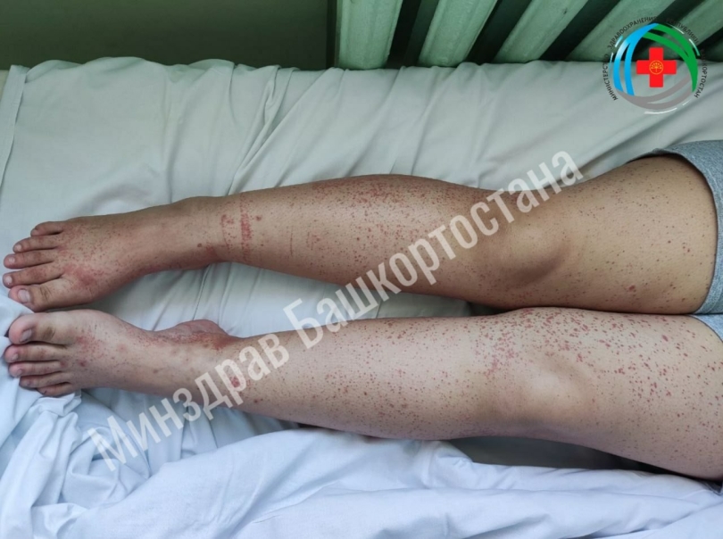 Уфимские врачи вылечили 12-летнюю девочку от редкого заболевания Уфимские врачи вылечили 12-летнюю девочку от редкого заболевания